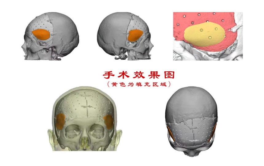 林志穎車禍致顏面骨折，醫(yī)生：或可用3D打印建模進(jìn)行術(shù)后修復(fù)
