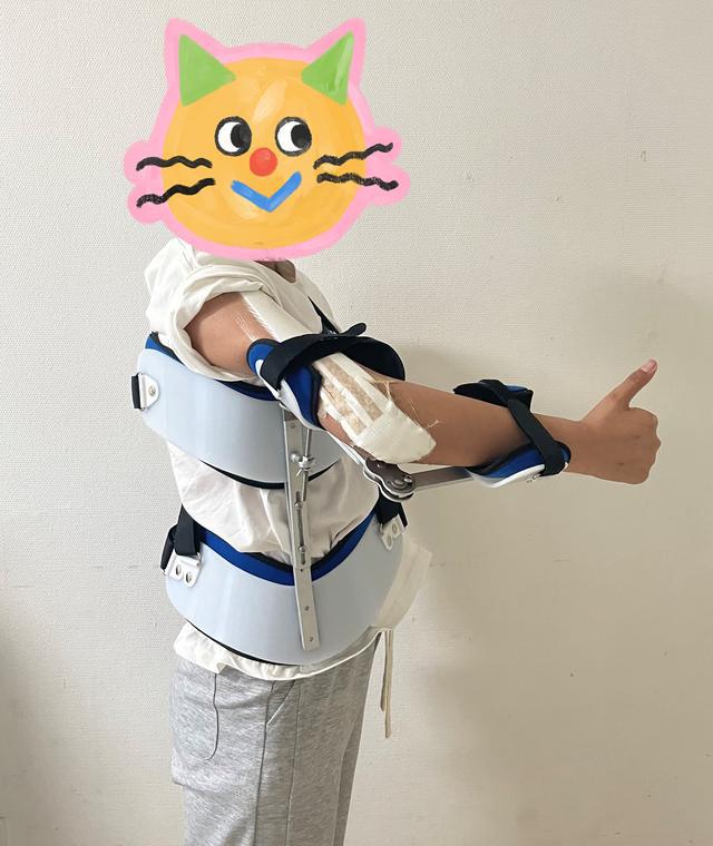 13歲少女患骨肉瘤面臨截肢，3D打印肱骨假體治療成功保肢