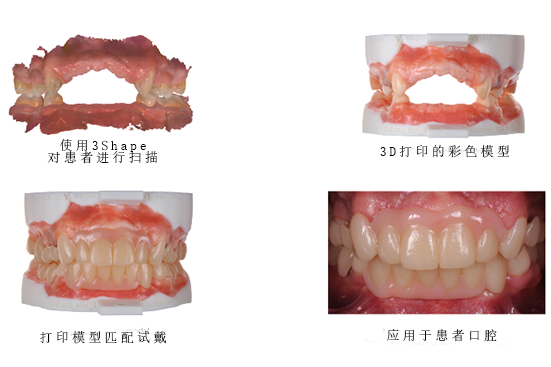 3Shape彩色工作流程，讓牙齒假體越來越“真”！
